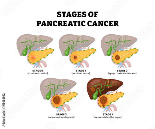 Stages of pancreatic cancer stages process. Pancreatic adenocarcinoma tumor development phase. Digestive system problem. Labeled liver and pancreas structure. Medical science illustration.