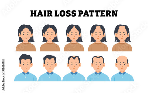 Stages of hair loss stages. Androgenetic alopecia male and female pattern character. Five stages of Baldness step. Balding process. Flat vector illustration.