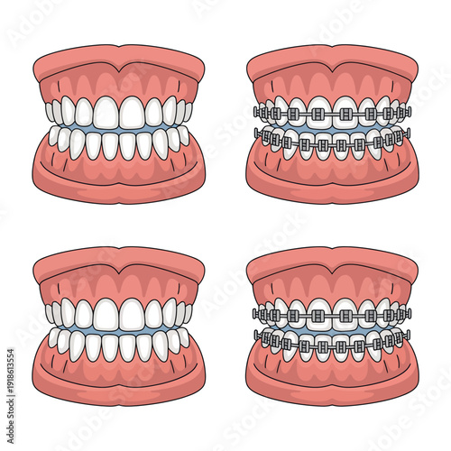 Dental braces treatment process for straightening teeth