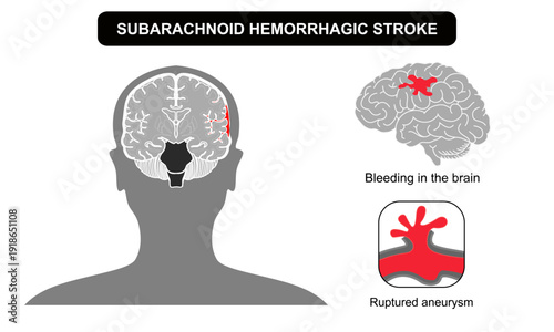Brain stroke hemorrhagic subarachnoid. Ruptured aneurysm, bleeding outside teh brain. Arteriosclerosis, infarct, ischemia, thrombosis disease. Medical poster vector illustration and education.