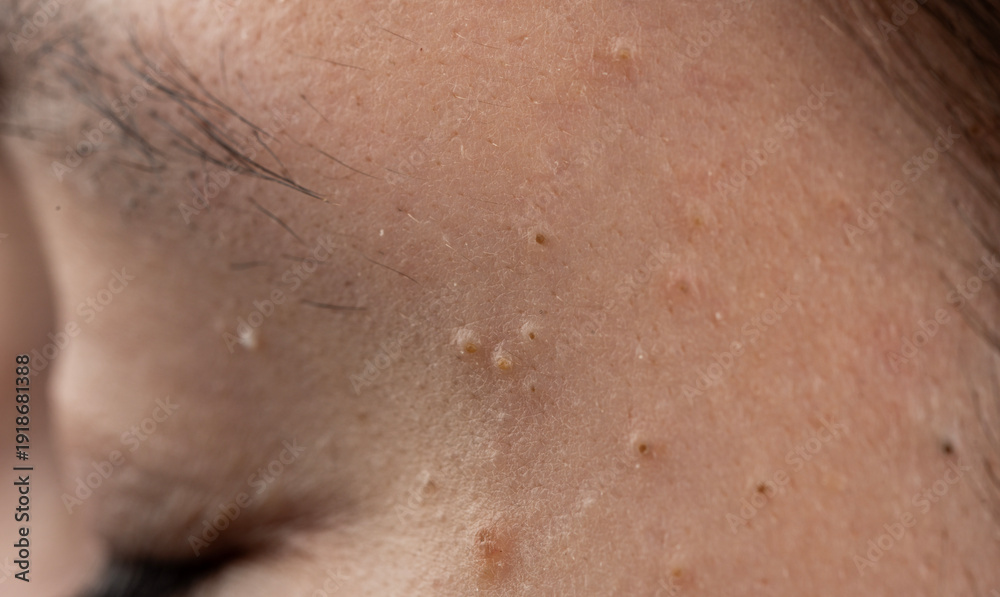 Naklejka premium Acne on skin with pustule and papules. Closeup of acne with inflamed follicles. Skincare for acne and irritated pores. Macro texture of acne with sebum.