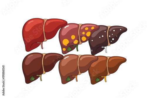 Liver vector illustration showing various healthy and unhealthy organ types
