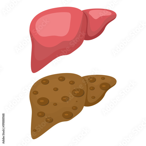 Flat vector illustration of a healthy liver vs. a healthy liver cirrhosis liver, showing human liver anatomy, disease comparison, medical, health, and organ education concepts.