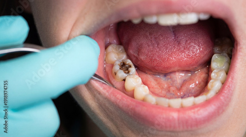 A dentist examines a large cavity in a patient's molar during a routine dental check-up