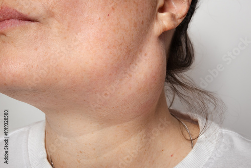 Woman with Brachial cleft cyst. Close up. Large inflamed cyst scheduled to be removed surgically after failed draining and infection. Large cyst or lump on side of neck. Selective focus.