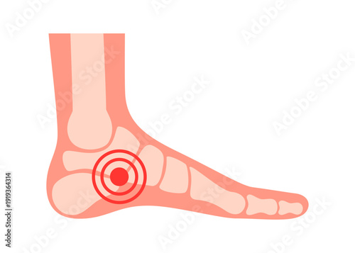Human foot bone structure with red painful spot. Ankle joint pain, injury, inflammation concept. Medical, healthcare. Vector illustration