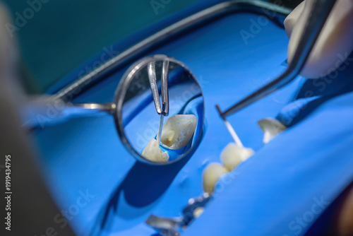 Close-up of root canal treatment under rubber dam isolation. Dentist cleaning and shaping infected canal using endodontic instruments in modern dental clinic.
