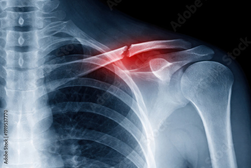 Shoulder X ray showing clavicle fracture with highlighted injury area. Medical imaging of bone trauma and orthopedic pathology.