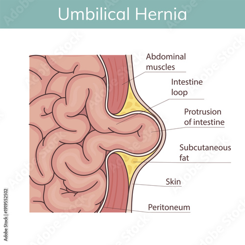 Umbilical hernia. Anatomical illustration drawn in cartoon style.
