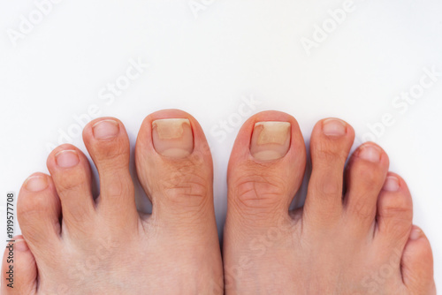 Фотография Close-up young woman's toenails with onycholysis