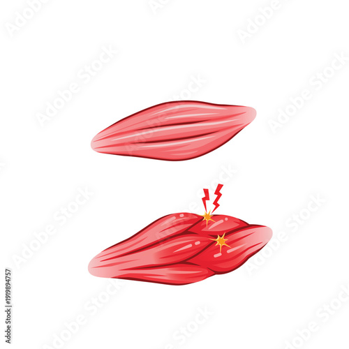 Illustration of Healthy Muscle and Inflamed Muscle