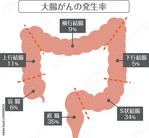 Colorectal Cancer Incidence Illustration	