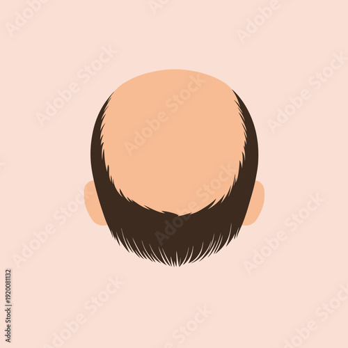 Minimalist flat vector illustration of male baldness crown with thinning hair and receding hairline viewed from above for hair loss concept