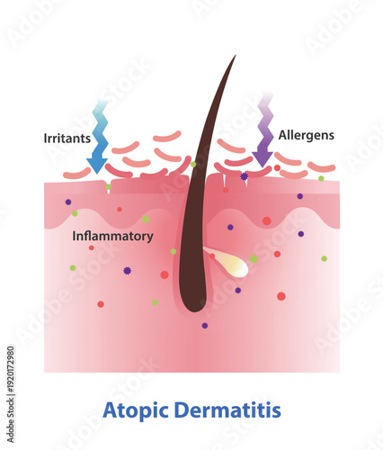 Atopic Dermatitis on skin layer illustration. Cross section of eczema, causes intensely itchy, red, inflamed skin. Both genetic and environmental factors leads to this condition. Skin care concept.