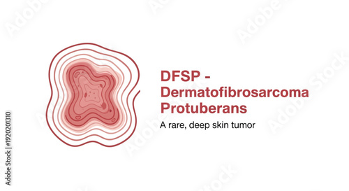 DFSP Dermatofibrosarcoma Protuberans medical illustration showing rare skin tumor layers.
