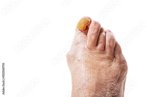 Old woman foot with onychogryphosis or ram horn nail disease. Medical condition, fungal infection concept for podiatry.