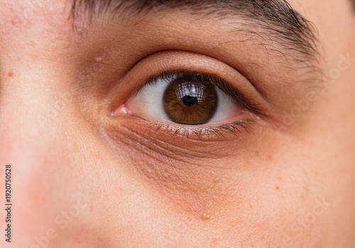 Close up of a male's brown eye with dark circles under the eye. Under eye circles. Sleep deprivation