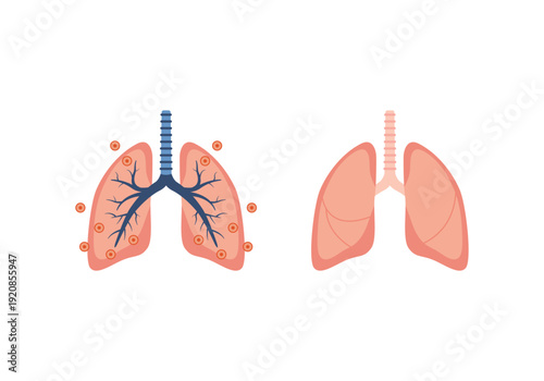 Healthy and Infected Lungs Medical Comparison Diagram