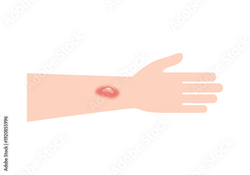 Itchy Mosquito Bite on Arm Skin. Insect Bite Skin Irritation Concept.