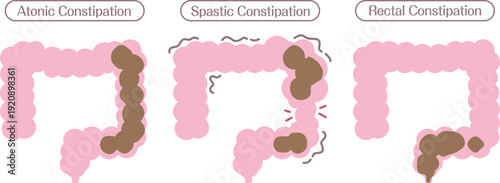 Types of Constipation Diagram Showing Atonic Spastic and Rectal Constipation