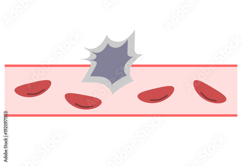 Cancer Cells Invading Blood Vessel Illustration for Metastasis and Oncology Education Concept