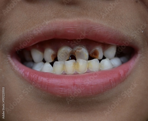 Close-up of a child’s mouth showing dental discoloration and early signs of tooth decay on primary front teeth.