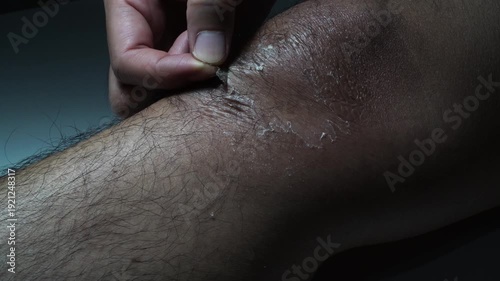 Skin wound after peeling on the knee.scar treatment concept