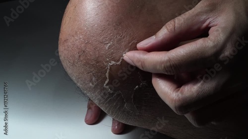 peeling the skin on the knees,skin disease.