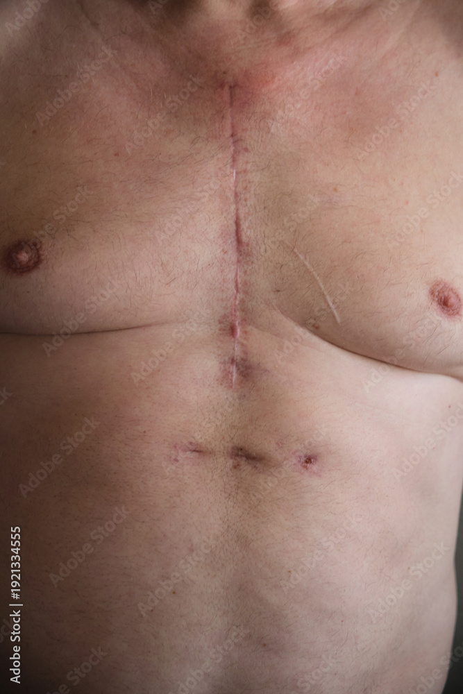 Naklejka premium scar on a man's chest after heart surgery
