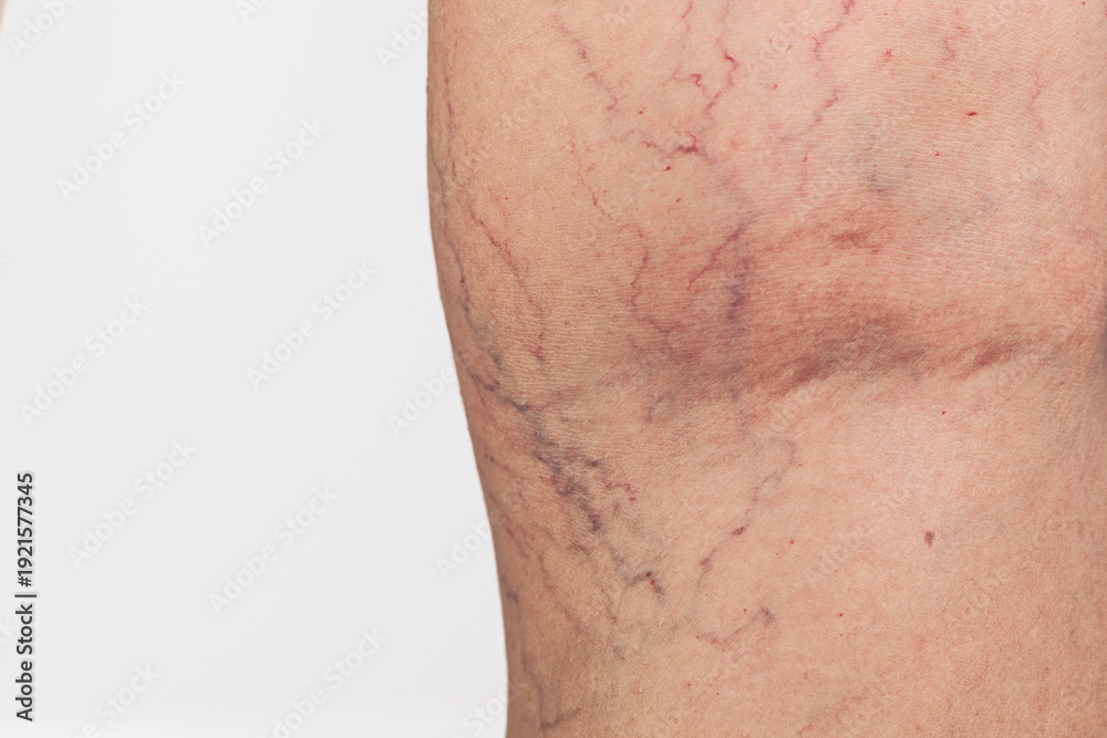 Fototapeta premium Close up of spider veins on female thigh, varicose vascular network and skin condition