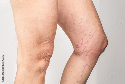 Quadro em tela Spider veins and varicose capillary network on female legs, vascular problem clo