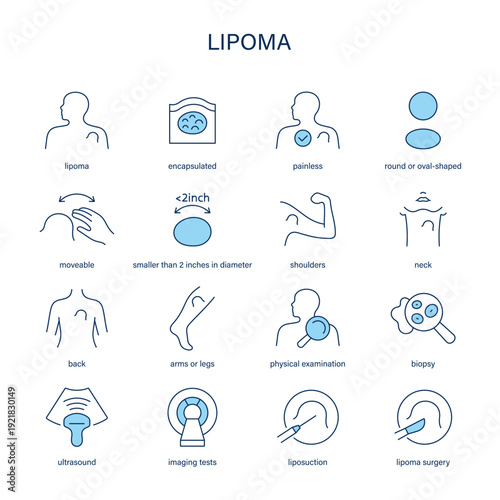 Lipoma symptoms, diagnostic and treatment vector icon set