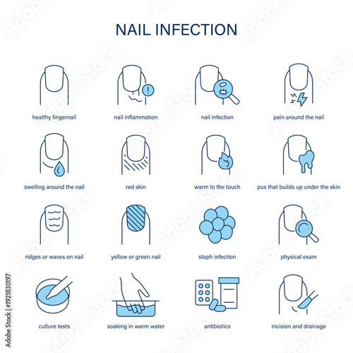 Nail Infection symptoms, diagnostic and treatment vector icon set