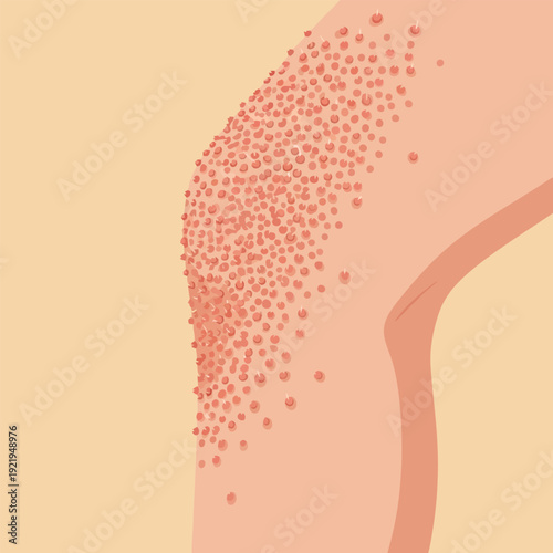 Keratosis Pilaris Skin Condition Illustration