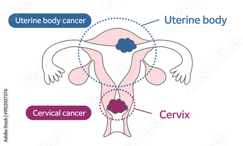 Medical Illustration of Uterine Body Cancer and Cervical Cancer