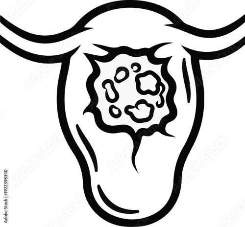 Uterus with uterine fibroids illustration