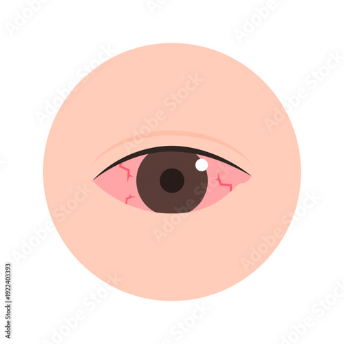 Irritated red eye. Healthcare, allergy, injury, symptom, care, infection, pain, treatment concepts. Flat vector design isolated illustration.