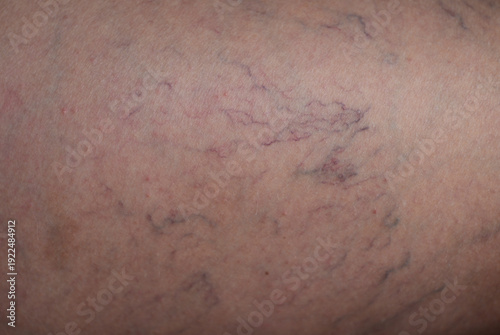 A close-up view of a leg skin fragment with varicose veins.