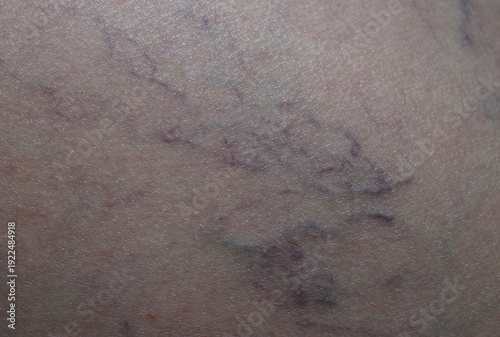 A close-up view of a leg skin fragment with varicose veins.