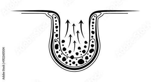 An anatomical illustration of a skin pore or cavity with particles and upward arrows indicating expulsion.