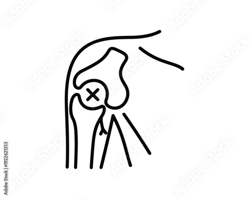 Shoulder joint dislocation anatomical illustration, medical diagram with injured shoulder joint.