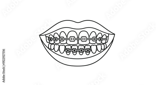 Smiling Mouth With Dental Braces