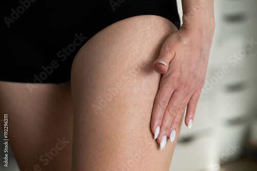 Woman applying cream on thigh with stretch marks, close-up of natural skin texture. Body care and dermatology concept. Real unretouched skin, self-care and cosmetic treatment theme.
