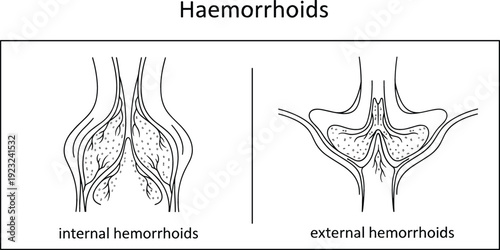 Medical illustration comparing internal and external hemorrhoids anatomy diagram for healthcare patient education and clinical information on white background