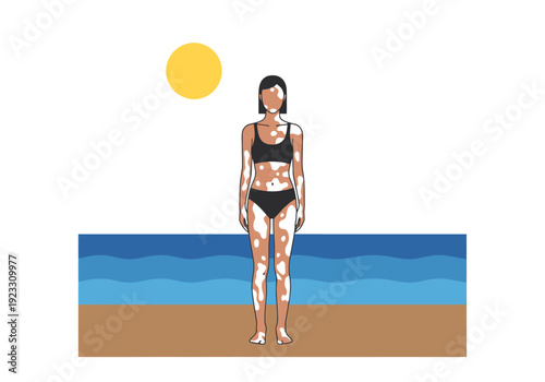 Woman displays depigmented skin condition standing on sandy beach facing ocean waves under bright sun