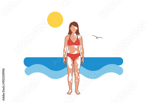 Dermatology condition graphic of person with skin pigmentation changes standing at the beach under the sun with ocean waves in background