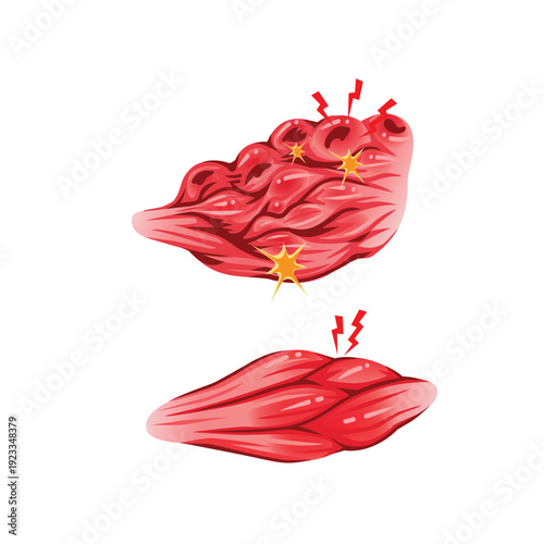 Damager Muscle Fibers and Inflamed Muscle