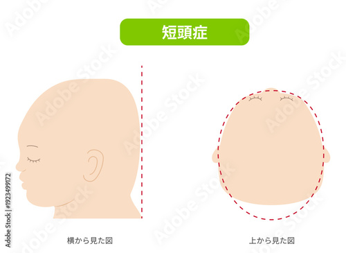 横と真上から見た頭の形に歪みがある斜頭症,短頭症,長頭症の赤ちゃんのイラスト