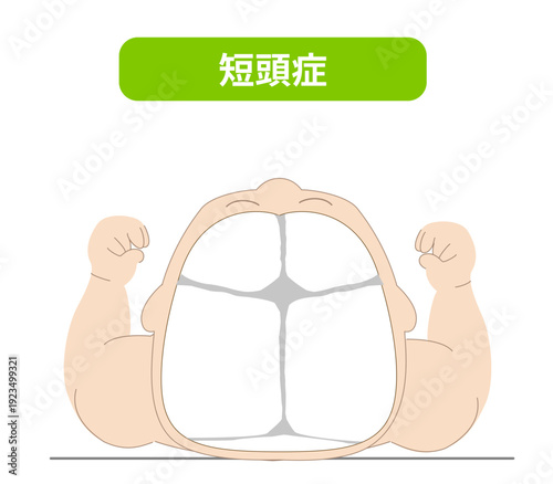 赤ちゃんが寝ている頭の向きによって頭の形に歪みが生じるメカニズム、斜頭症,短頭症,長頭症の赤ちゃんのイラスト