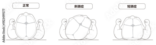 白黒線画　赤ちゃんが寝ている頭の向きによって頭の形に歪みが生じるメカニズム、斜頭症,短頭症,長頭症の赤ちゃんのイラスト